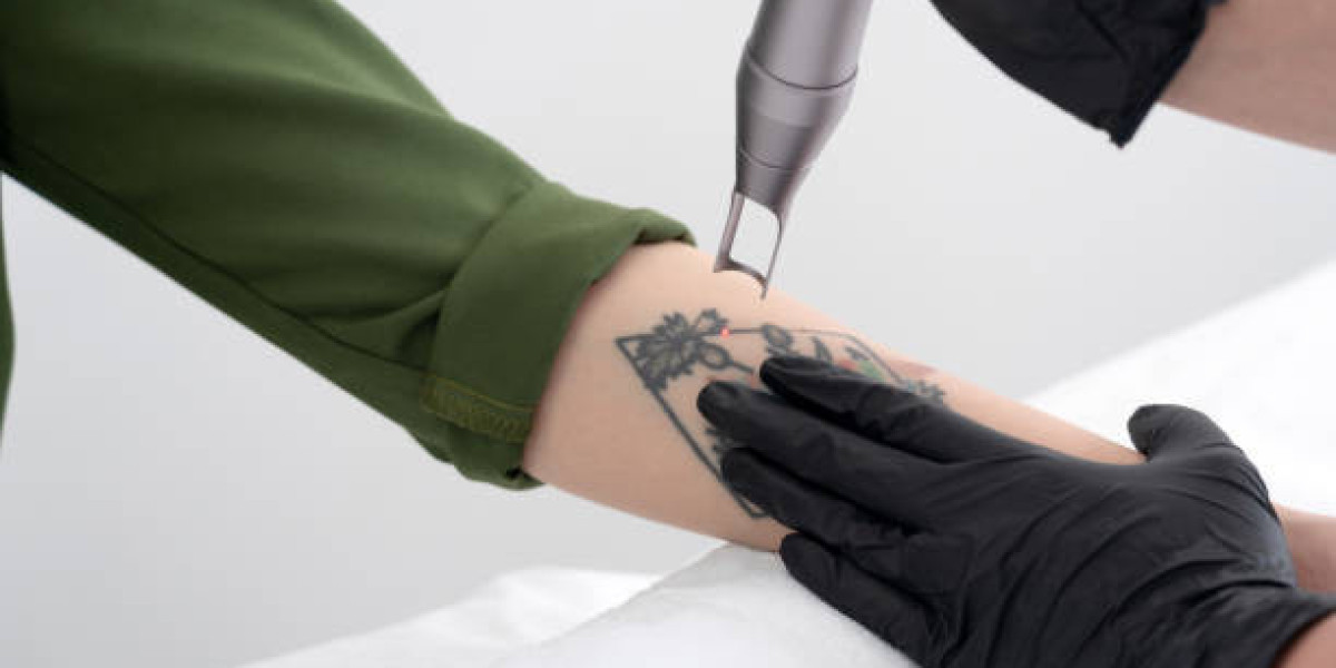 How Many Sessions Does Laser Tattoo Removal Require?