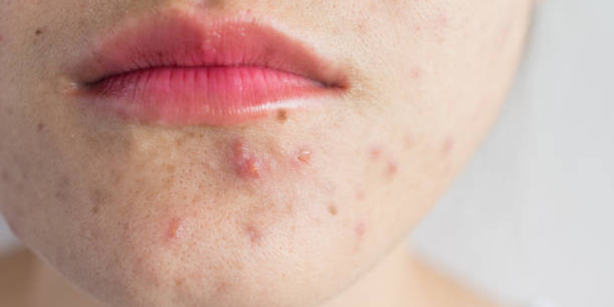 Acne Treatment Strategies for Naturally Healthy Skin Results