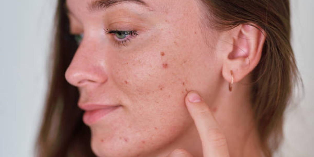 What Happens During an In‑Office Skin Tag Removal Visit?