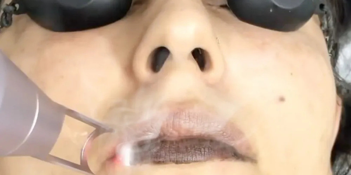Latest Techniques Used for Smoker Lips Treatment in Islamabad