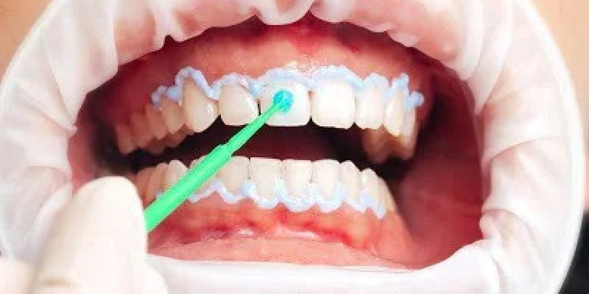 Hydrogen Peroxide Teeth Whitening for Healthy-Looking Teeth
