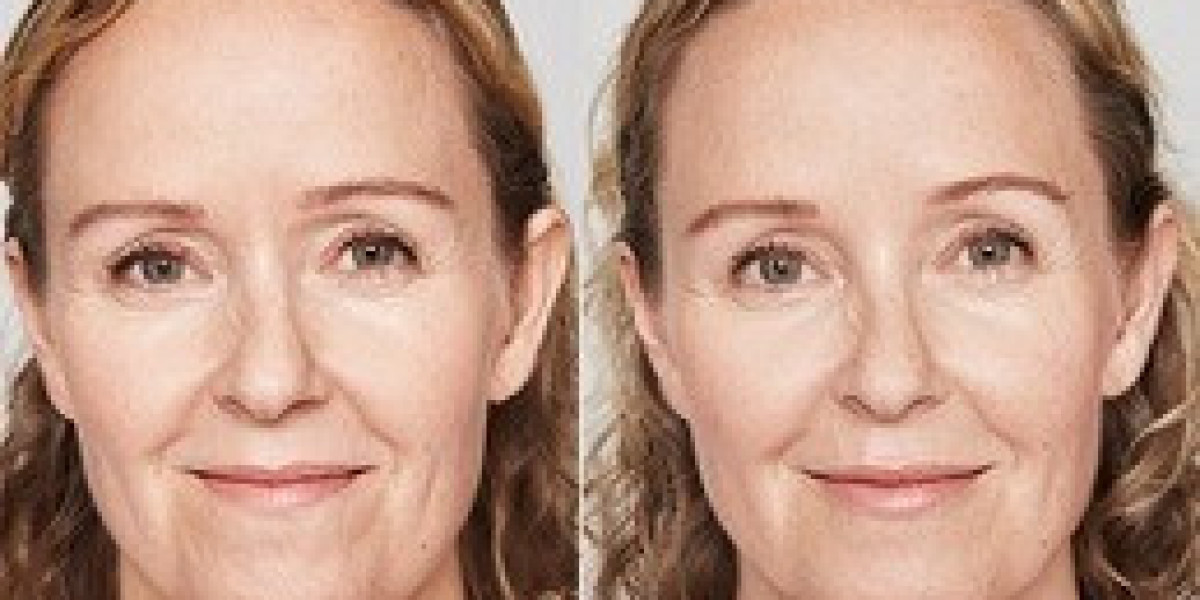 Restylane Casey in Dubai | Achieve Natural-Looking Facial Rejuvenation